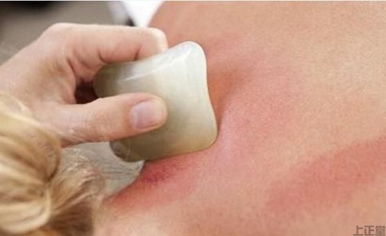刮痧如何缓解腰椎间盘突出