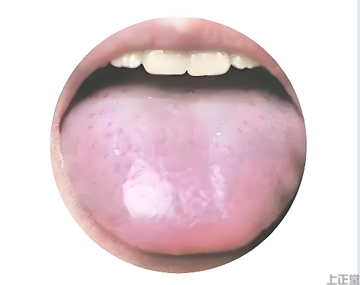 舌诊判断脾胃虚弱